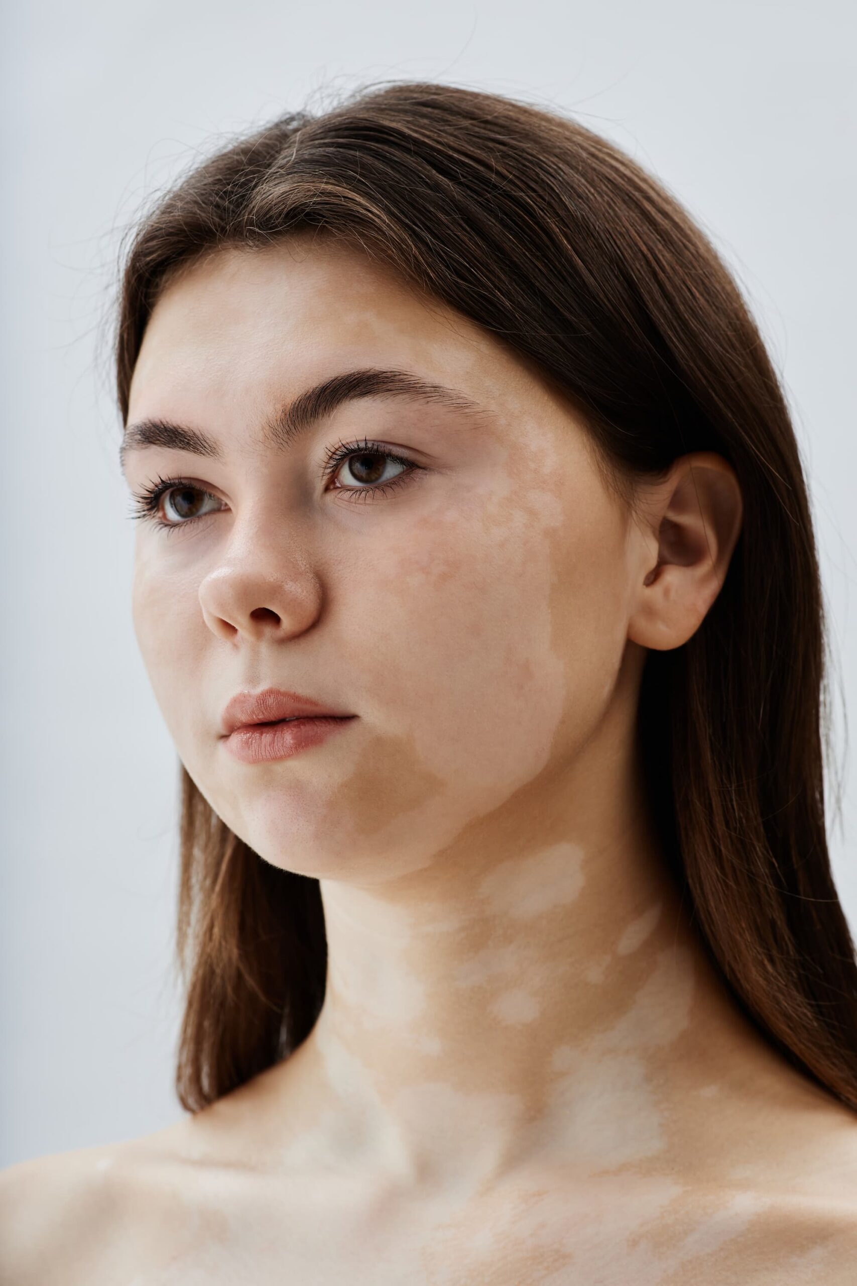 portrait-of-young-woman-with-vitiligo-embracing-sk-2025-03-06-07-07-46-utc (1)